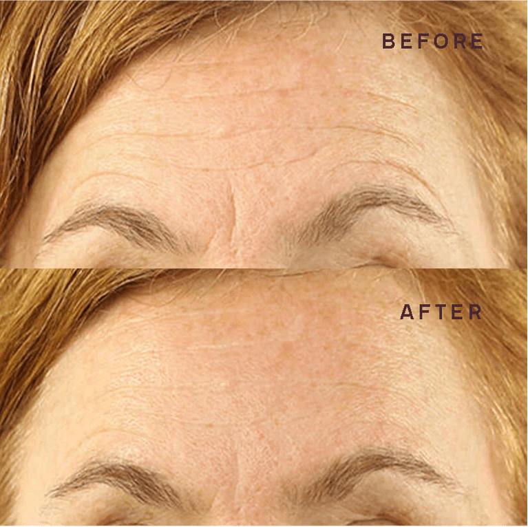 Ephylift Beauty Face kit - 5 Pflaster