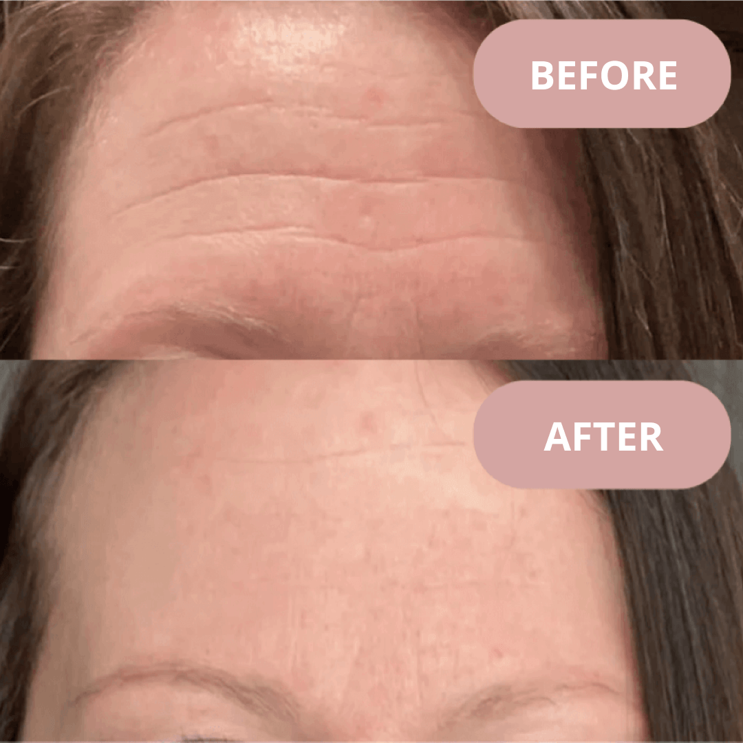 Ephylift Beauty Face kit - 5 Pflaster