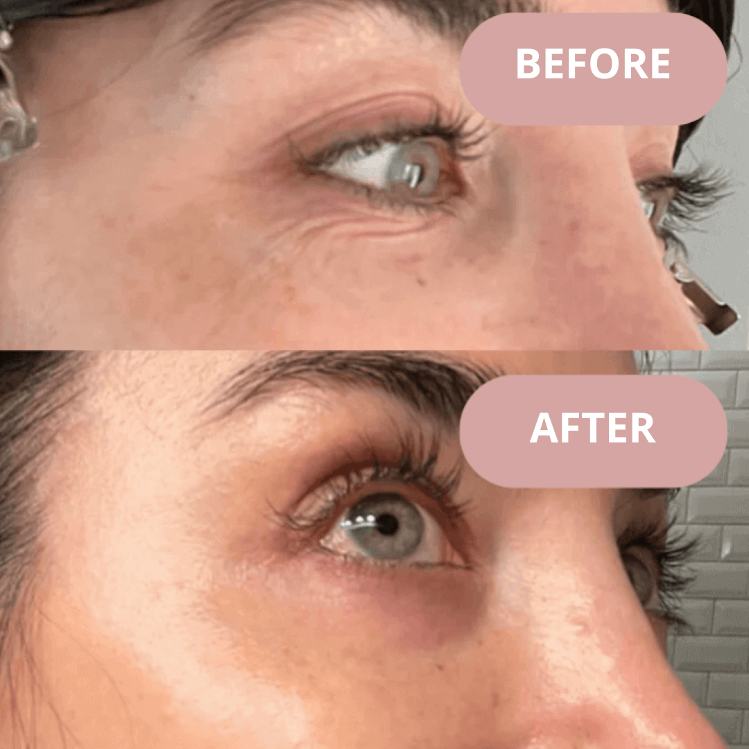 Ephylift Beauty Face kit - 5 Pflaster