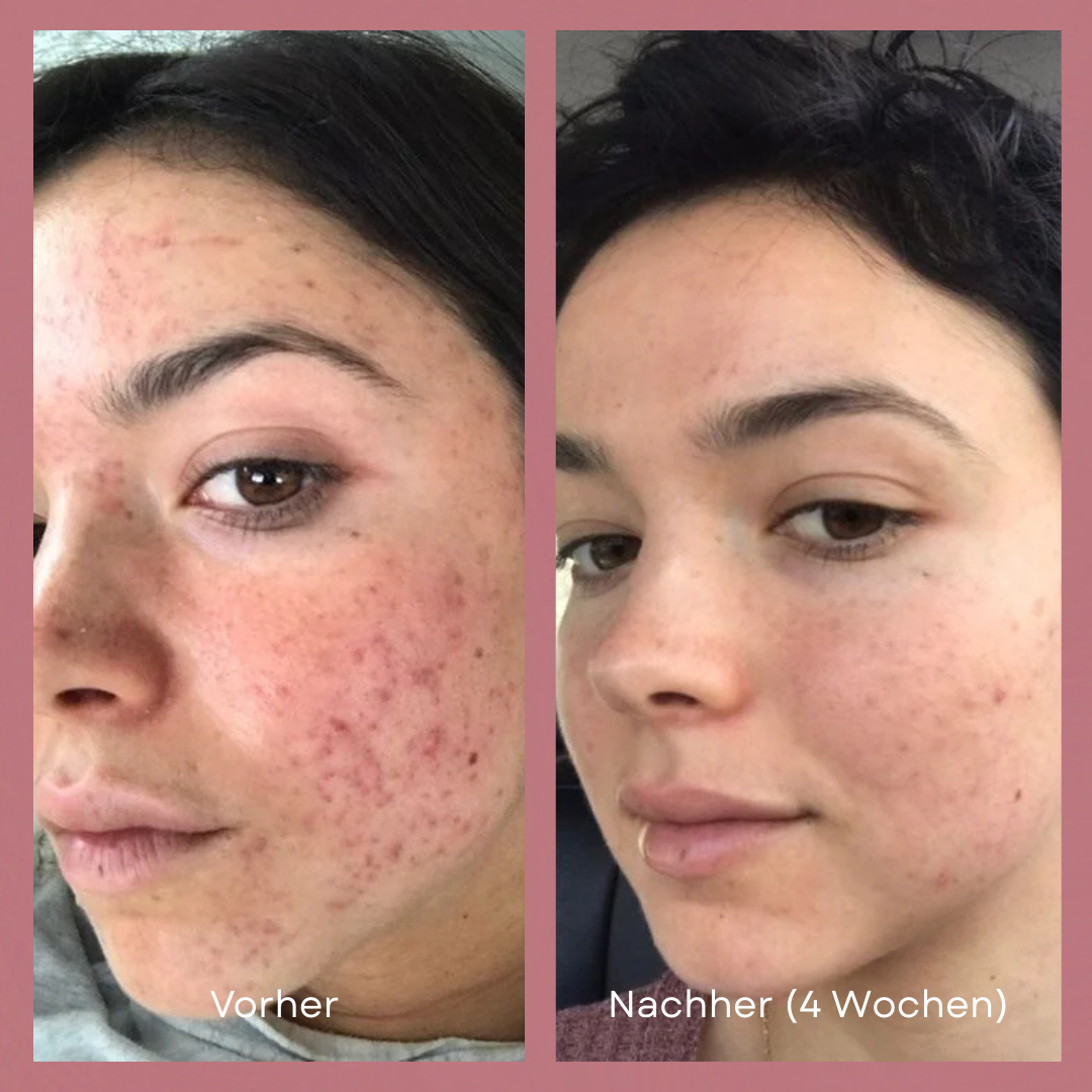 Lumi LED Lichttherapie Maske