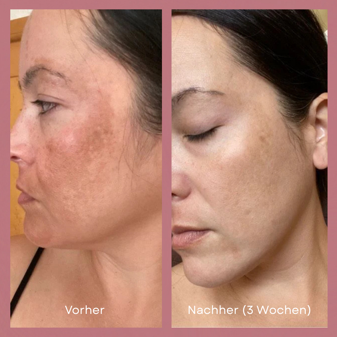 Lumi LED Lichttherapie Maske