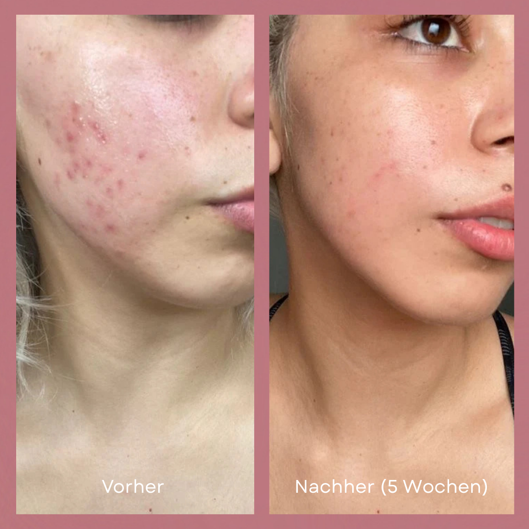 Lumi LED Lichttherapie Maske