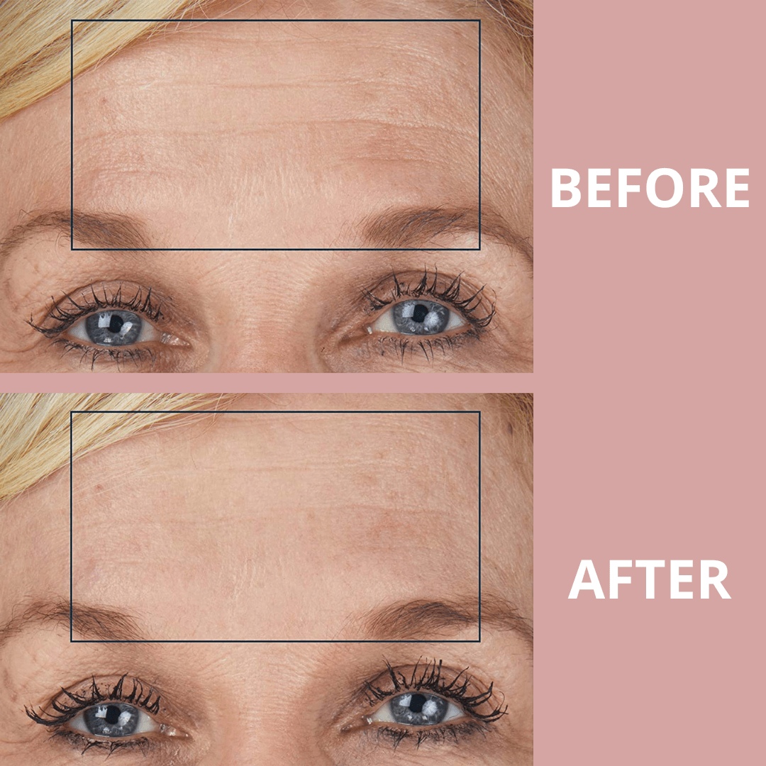 Ephylift Beauty Face kit - 5 Pflaster